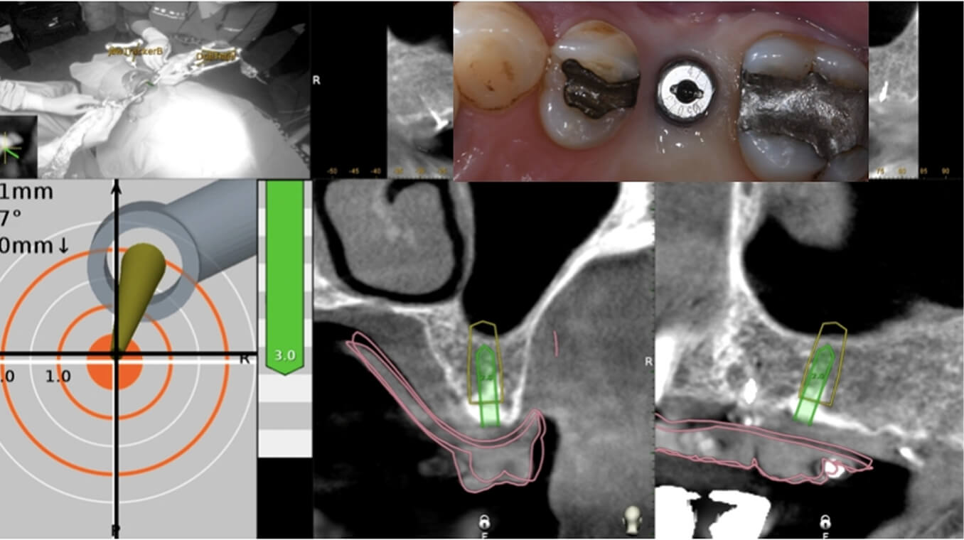 文西微創   無痛植牙
