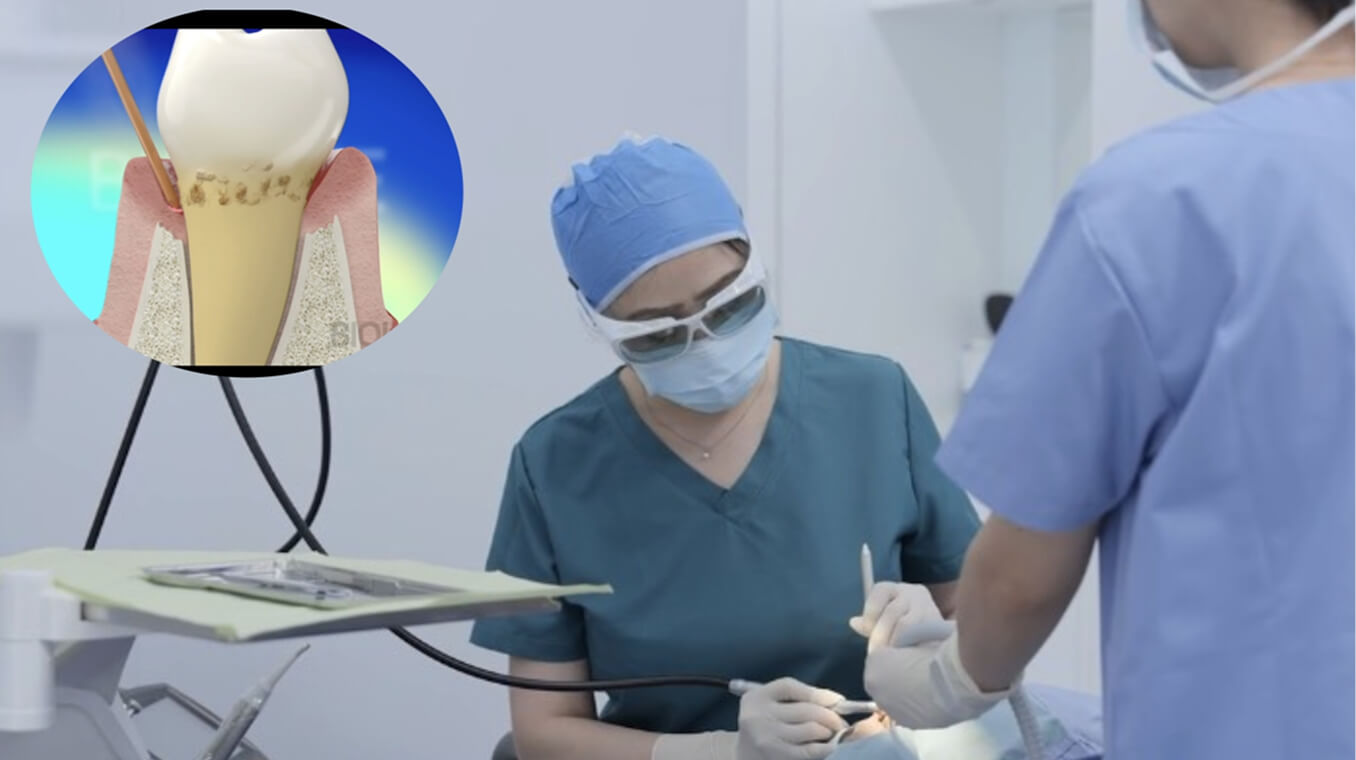 水雷射牙周再生